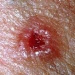 basal cell carcinoma cannabis oil treatment and skin cancer