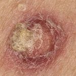 cannabis oil treatment for skin cancer images